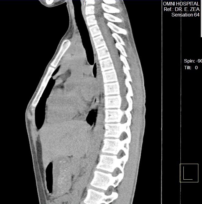 PECTUS CARINATUM TAC CORTE SAGITAL