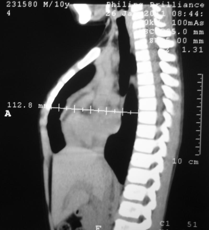 PECTUS CARINATUM TAC CORTE SAGITAL 2
