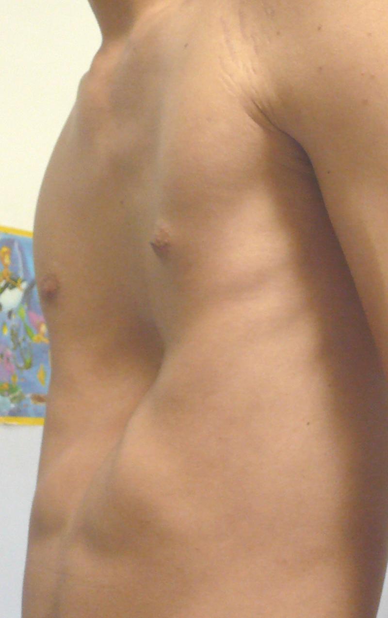 PECTUS EXCAVATUM