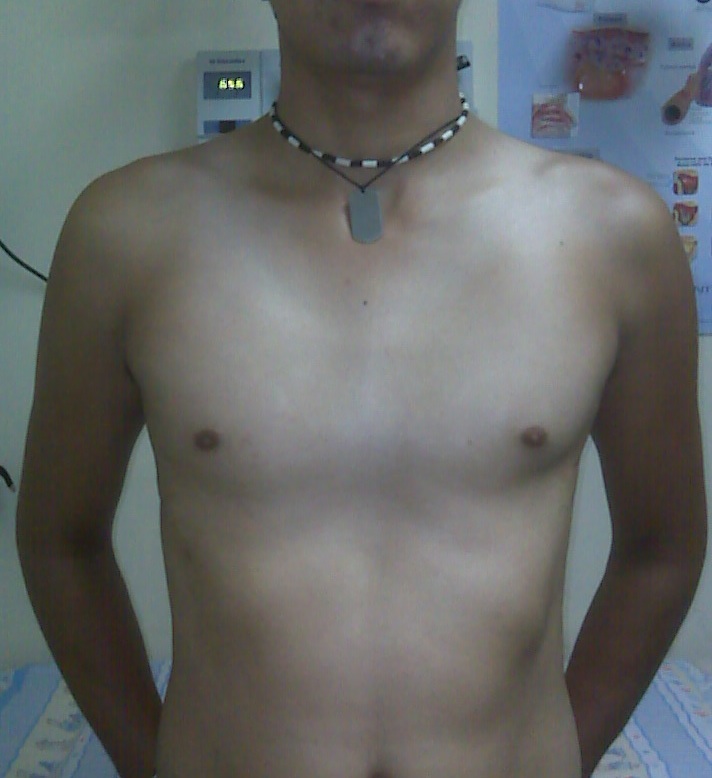 excavatum tipo plato resultado
