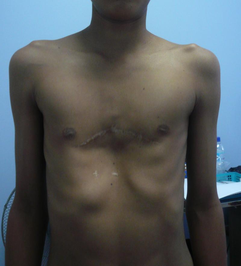 Pectus excavatum recidivante