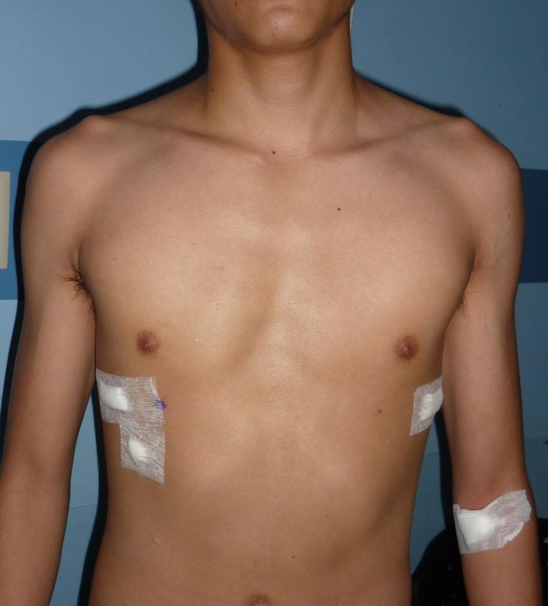 Operacion de nuss resultado 3
