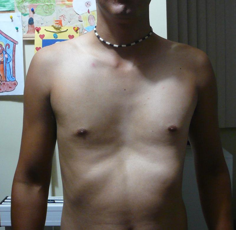 pectus excavatum tipo plato